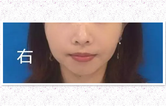 打瘦脸针后每天的感受 肉毒素也不是即刻见效
