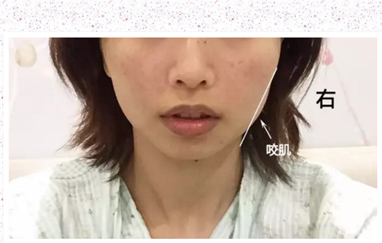 打瘦脸针后每天的感受 肉毒素也不是即刻见效