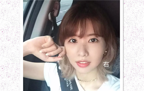 打瘦脸针后每天的感受 肉毒素也不是即刻见效