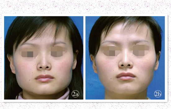 瘦脸针三次能定型吗 保持好习惯咬肌会小很多