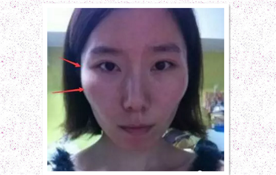 打瘦脸针后为什么显老 这3个原因导致你变美不成反显老