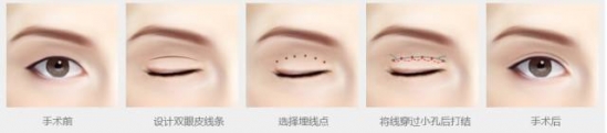 双眼皮手术恢复过程 割双眼皮,为什么你恢复的比别人慢?