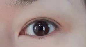 双眼皮手术恢复过程 割双眼皮,为什么你恢复的比别人慢?