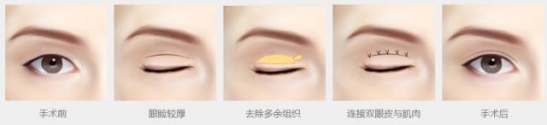 双眼皮手术恢复过程 割双眼皮,为什么你恢复的比别人慢?