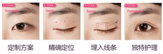 双眼皮手术恢复过程 割双眼皮,为什么你恢复的比别人慢?