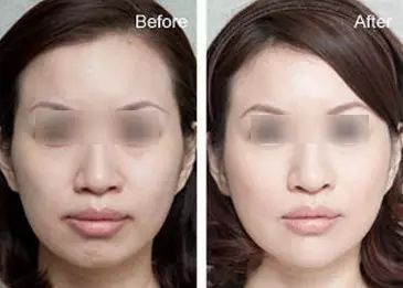 自体脂肪填充面部凹陷 面部凹陷的女人为什么会显老?