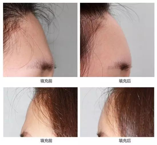 自体脂肪填充面部凹陷 面部凹陷的女人为什么会显老?