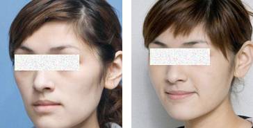 自体脂肪填充面部凹陷 面部凹陷的女人为什么会显老?