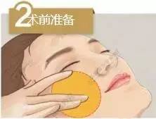 线雕是什么 线雕不是整容，是微调！！！