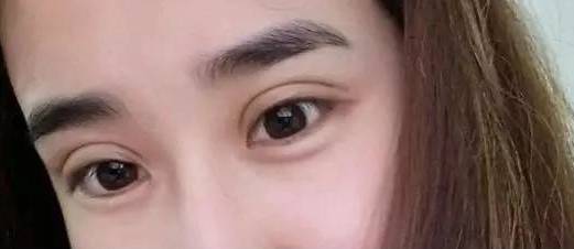 双眼皮术后注意事项 双眼皮术后恢复必经五个阶段