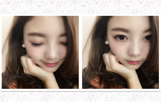 瘦脸针痛不痛 疼痛感很小只是短暂的咀嚼时咬肌酸胀