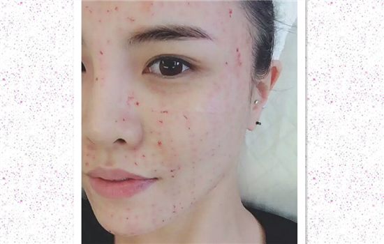 菲洛嘉水光针副作用 这5大副作用你知道几个呢