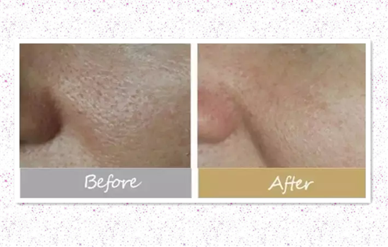 菲洛嘉青春动能素前后效果 看完后我完全惊呆了