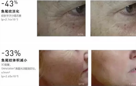 菲洛嘉青春动能素前后效果 看完后我完全惊呆了