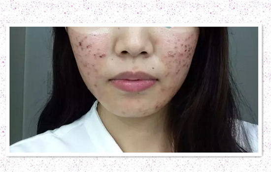 激光祛痘坑要多少次 只做一次激光祛痘坑皮肤不会变好