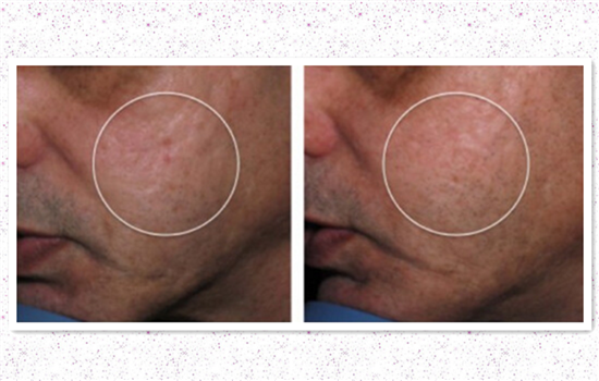 激光祛痘后有复发的吗 不注重这三点也有反弹的可能