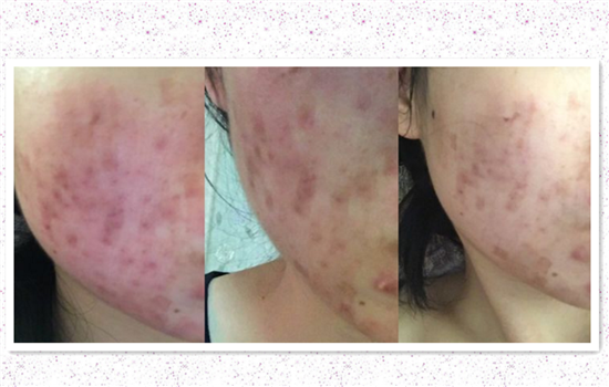 激光祛痘后有复发的吗 不注重这三点也有反弹的可能