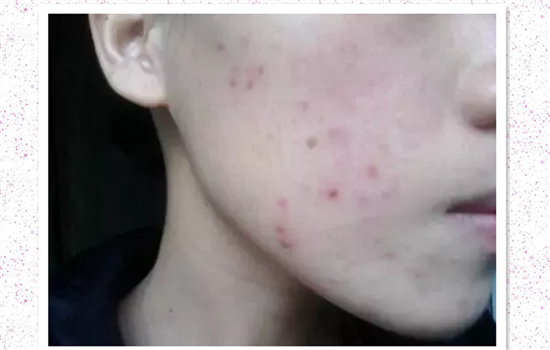 激光祛痘印多久能恢复 恢复好不反黑的关键竟然是这个