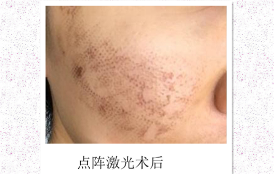 激光祛痘印多久能恢复 恢复好不反黑的关键竟然是这个