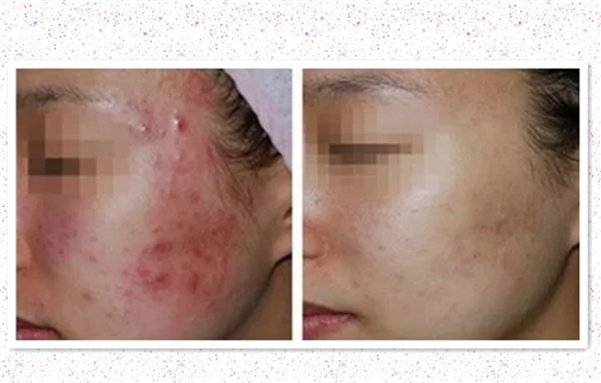 激光去痘印的坏处 这5大风险一定会让你震惊