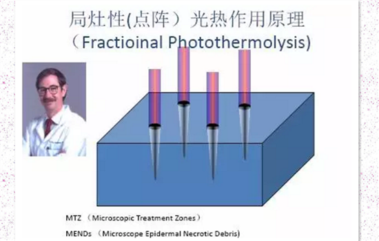 激光去痘印的坏处 这5大风险一定会让你震惊