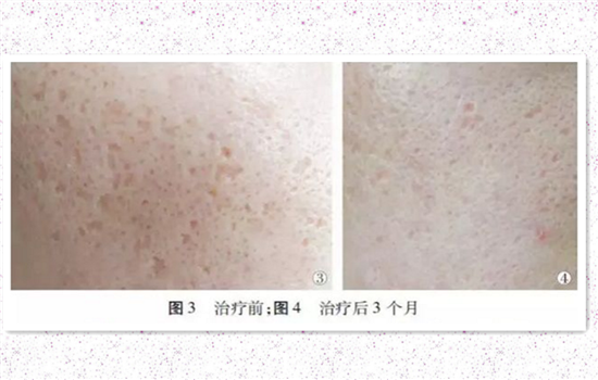 点阵激光去痘印有效吗 爱长痘的妹纸都应该知道的秘密