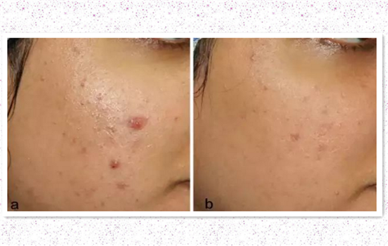 点阵激光去痘印有效吗 爱长痘的妹纸都应该知道的秘密