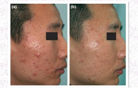 点阵激光去痘印有效吗 爱长痘的妹纸都应该知道的秘密