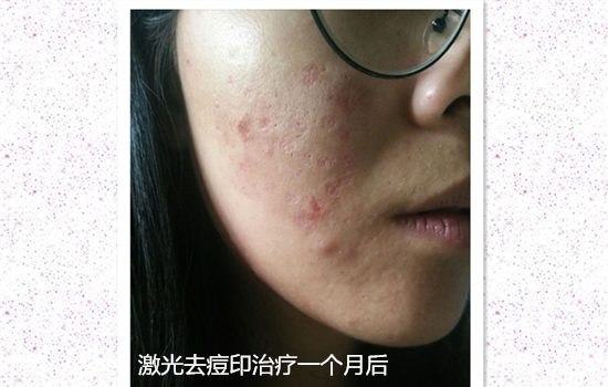 激光去痘印后会反黑吗 揭秘激光术后反黑的真实原因