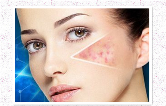 激光去痘印会留疤吗 不规范操作肯定会有疤