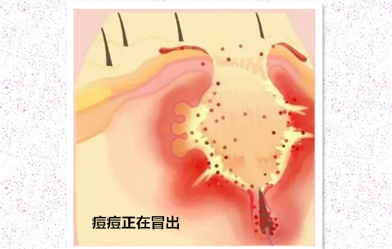 激光去痘印过程 医美清除痘印的秘密你知道吗