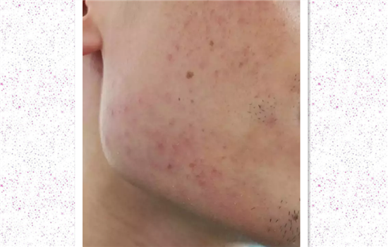 激光祛痘印后恢复过程 医美方式去痘印究竟要多久恢复