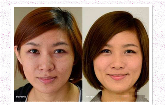 激光去痘印经历 来自医美启蒙博主的分享