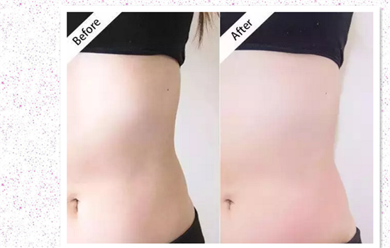 tripollar pose效果 真的能熨平岁月留在你身上的印记吗