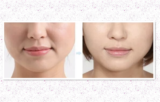 填充法令纹后笑会僵吗 触犯这4个禁忌才会导致脸变僵硬