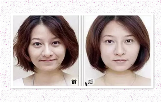 填充法令纹后笑会僵吗 触犯这4个禁忌才会导致脸变僵硬