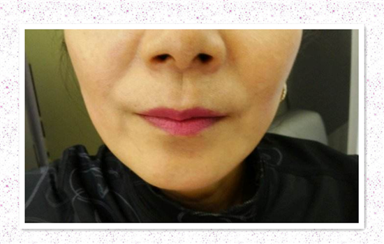 填充法令纹后悔死图片 8张图片揭示填法令纹的危害