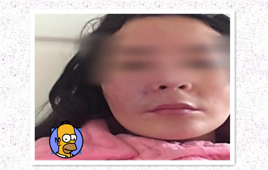 填充法令纹后悔死图片 8张图片揭示填法令纹的危害