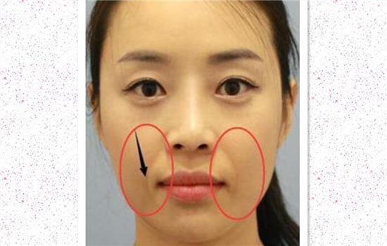 填充法令纹后悔死图片 8张图片揭示填法令纹的危害
