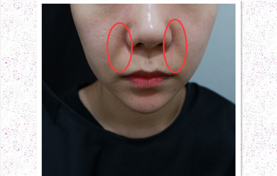 法令纹填充后感觉脸胖 如何一键解决填充后脸胖问题