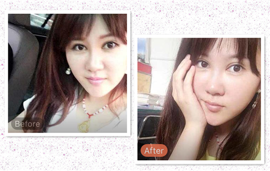 法令纹填充前后照片 6张达人对比照告诉你最真实的效果