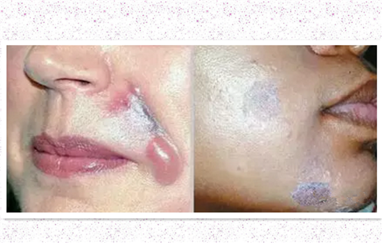 玻尿酸打下巴失败图片 非法医美导致下巴烂掉你不怕吗