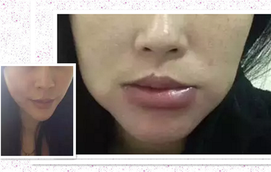 玻尿酸打下巴失败图片 非法医美导致下巴烂掉你不怕吗