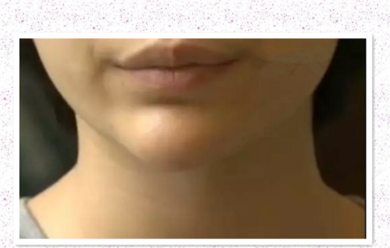 玻尿酸打下巴失败图片 非法医美导致下巴烂掉你不怕吗