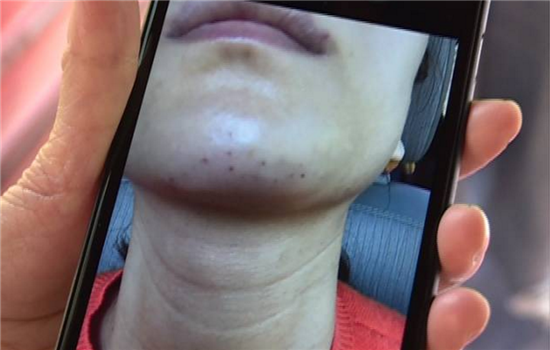 玻尿酸打下巴失败图片 非法医美导致下巴烂掉你不怕吗