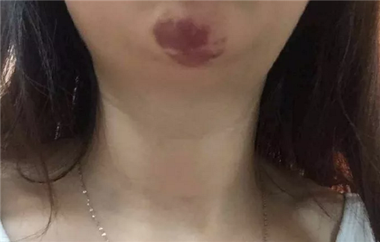 玻尿酸打下巴失败图片 非法医美导致下巴烂掉你不怕吗
