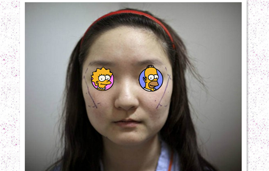 脂肪填充法令纹毁容 看完你还敢轻易填充法令纹吗