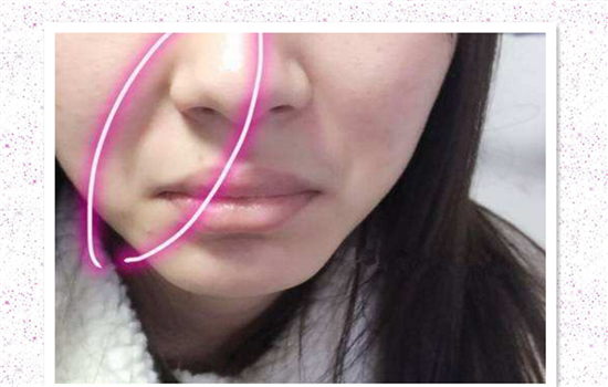 脂肪填充法令纹毁容 看完你还敢轻易填充法令纹吗