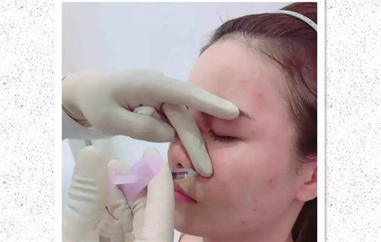 玻尿酸填充法令纹经历 前后对比效果惊人