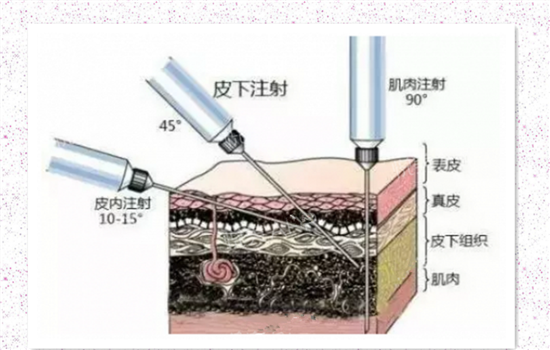 川字纹玻尿酸注射方法 静态川字纹辅助治疗可以这样做